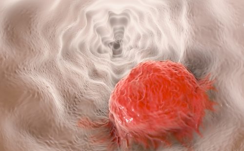 Esophageal cancer, 3D illustration showing tumor on the wall of esophagus